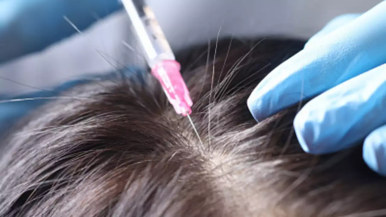 Decoding Hair Transplant Surgery in Bangalore: What to Expect